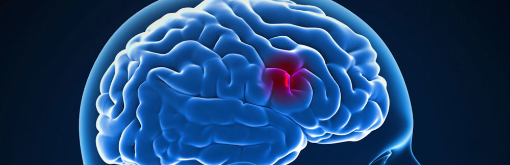 Ile się żyje po udarze mózgu? Przegląd najnowszych badań.